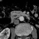 Pancreas divisum on CT, mininum intensity projection, MinIP: CT - Computed tomography